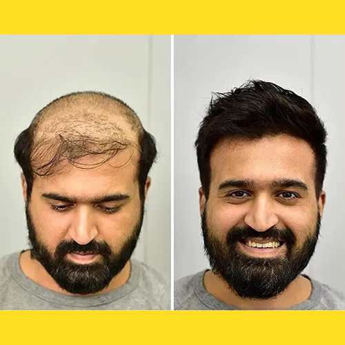 Non Surgical Hair Replacement in Malleshwaram