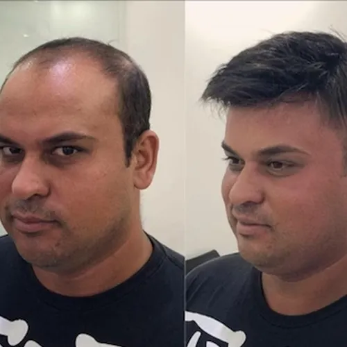 Non Surgical Hair Replacement in Marathahalli