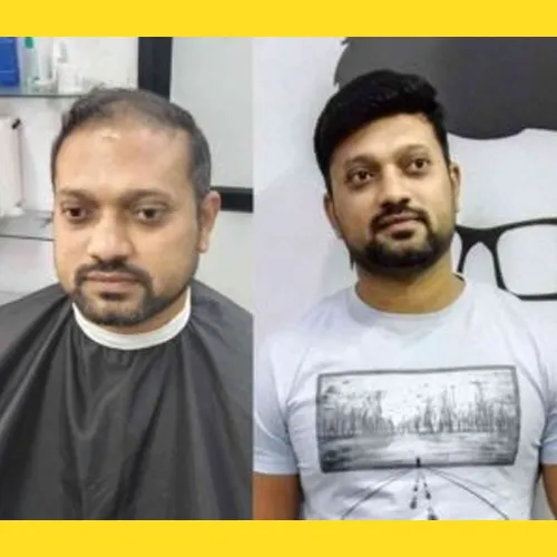 Non Surgical Hair Replacement in MG Road