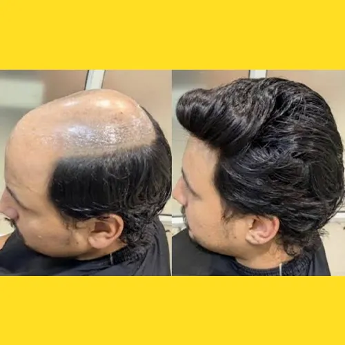 Non Surgical Hair Replacement in Sarjapur