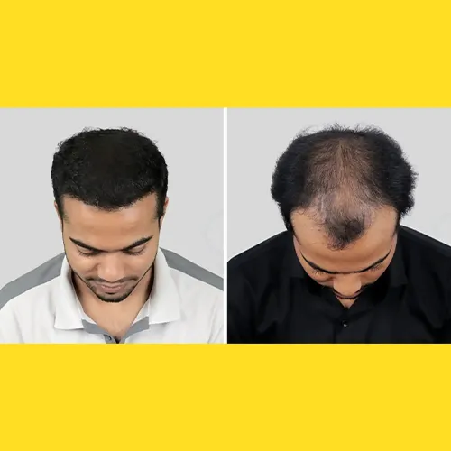 Non-surgical Hair Replacement In Bachupally