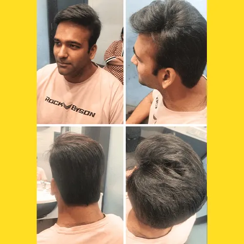 Non surgical hair replacement for men in Bangalore