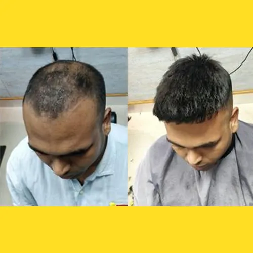 Hair replacement Hyderabad