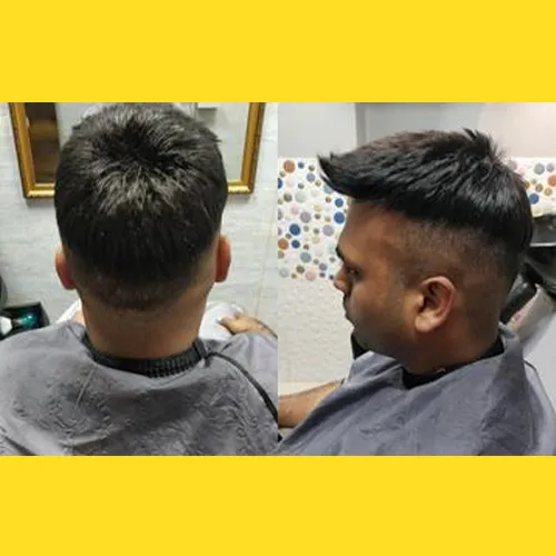 Non Surgical Hair Replacement In Hyderabad