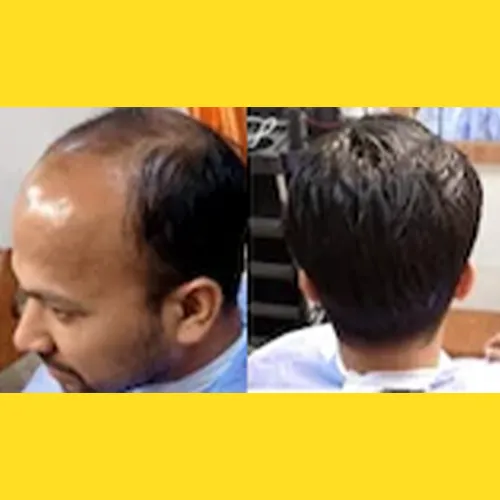 Hair Wigs In Electronic City