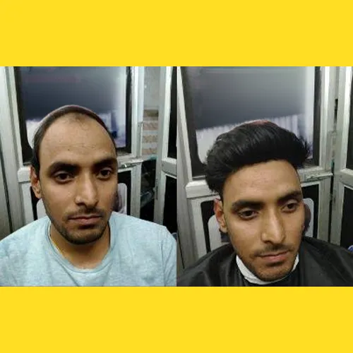 Hair Wigs In Banjara Hills