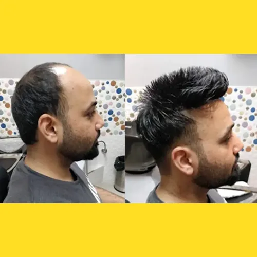 Hair Wigs In Jubilee Hills
