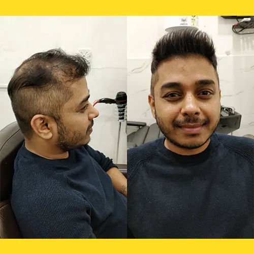 Hair Wigs In Kukatpally