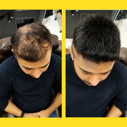 Hair Wigs Near Malleshwaram