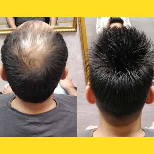 Hair Wigs Near Indira Nagar