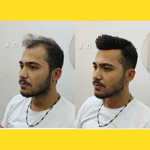 Hair Wigs in Hyderabad